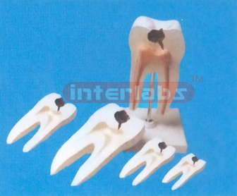 MIDDLE CARIES MOLAR, (2 purchase)